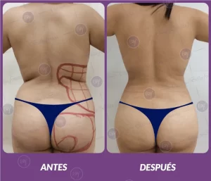 Lipotransferencia 6